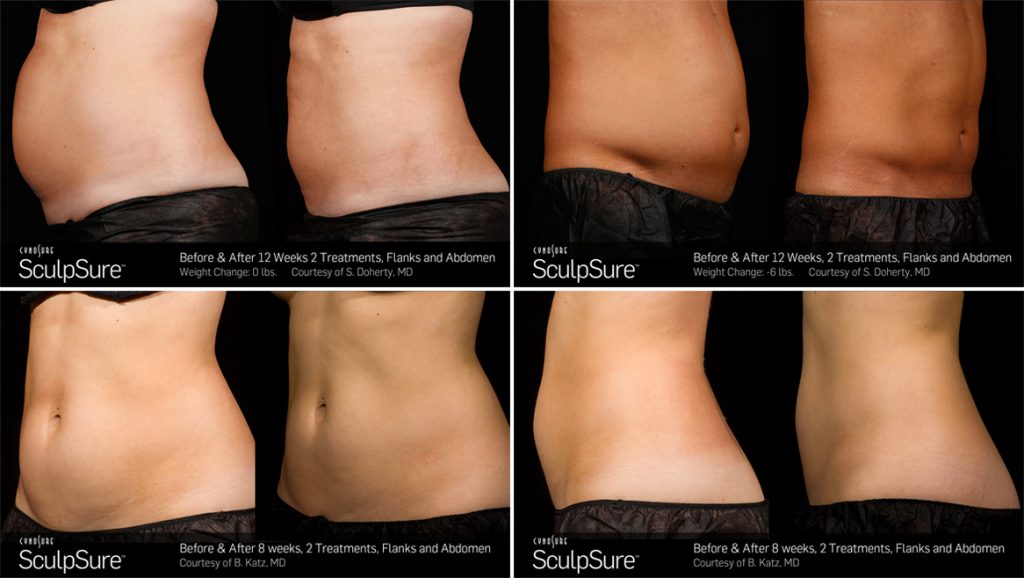SculpSure Before and After Photos